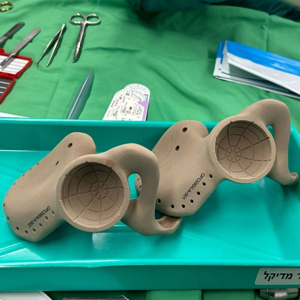 The 3D printed artificial pelvis implanted in Mark's body.